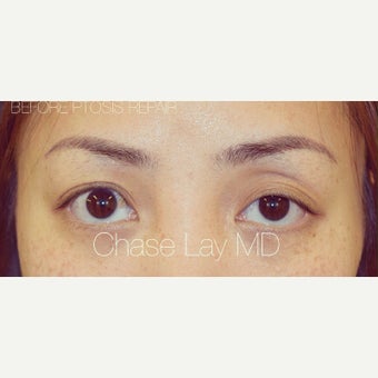 25-34 year old woman treated with Asian Eyelid Surgery and ptosis repair before 2574254