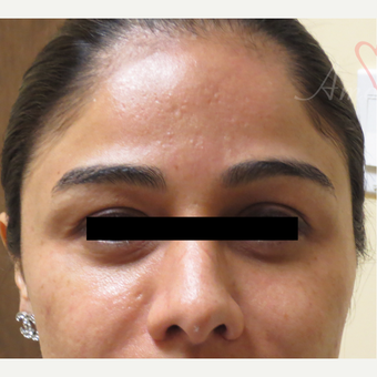 25-34 year old woman treated with Fractional Laser before 3375004