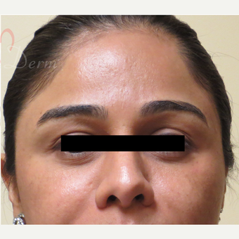 25-34 year old woman treated with Fractional Laser after 3375004