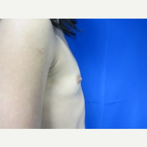 Breast Augmentation before 3054922
