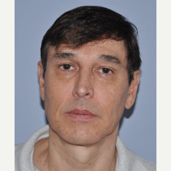 55-64 year old man treated with Facelift before 3603850