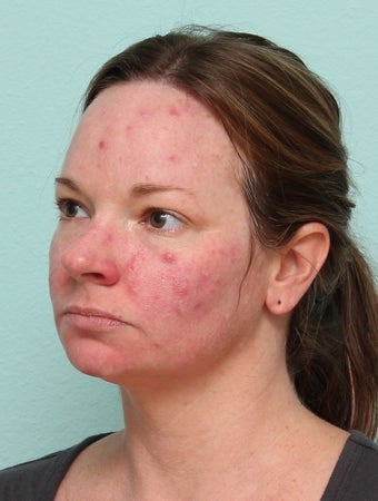 33 Year Old Female Treated for Acne 1227177