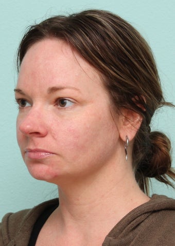 33 Year Old Female Treated for Acne 1227177