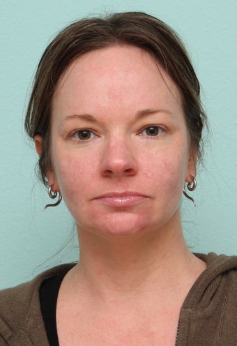 33 Year Old Female Treated for Acne after 1227177