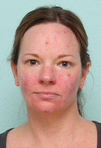 33 Year Old Female Treated for Acne before 1227177