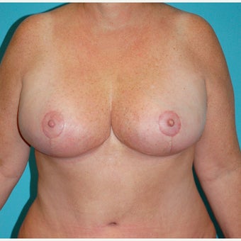 45-54 year old woman treated for Breast Reduction after 2615680