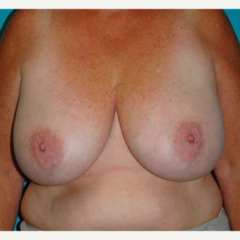 45-54 year old woman treated for Breast Reduction before 2615680