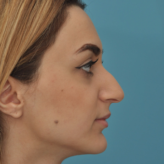 25-34 year old woman treated with Rhinoplasty before 3524701