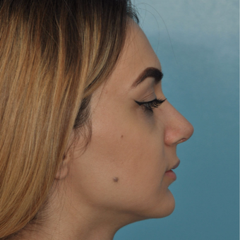 25-34 year old woman treated with Rhinoplasty after 3524701