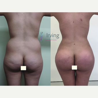 18-24 year old woman treated with Brazilian Butt Lift before 3538798