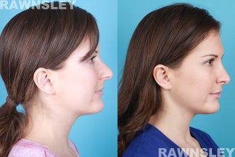 Revision Rhinoplasty after 985221