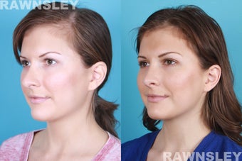 Revision Rhinoplasty before 985221