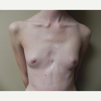 18-24 year old woman treated with Breast Augmentation before 3378476