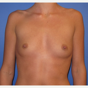 25-34 year old woman treated with Breast Augmentation (R. 295cc, L. 275cc) before 3544316