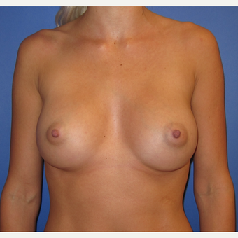 25-34 year old woman treated with Breast Augmentation (R. 295cc, L. 275cc) after 3544316