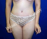 25-34 year old woman treated with Liposuction after 3727491