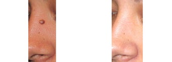Mole Removal photos before 951886