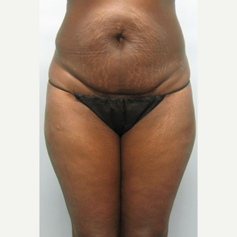 45-54 year old woman treated with Tummy Tuck before 1545342