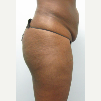 45-54 year old woman treated with Tummy Tuck 1545342