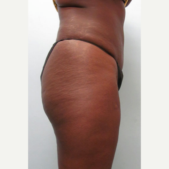 45-54 year old woman treated with Tummy Tuck 1545342