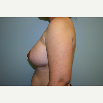 Breast Augmentation after 3560639