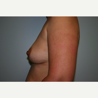 Breast Augmentation before 3560639
