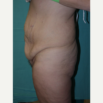 Tummy Tuck before 3743963