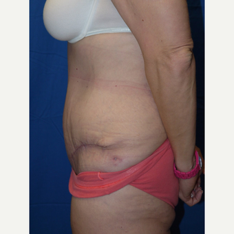 Tummy Tuck after 3743963