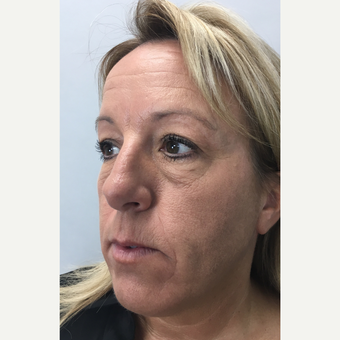 35-44 year old woman treated with Dysport before 3802751