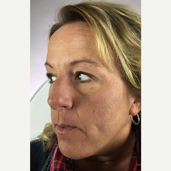 35-44 year old woman treated with Dysport after 3802751