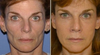 45-54 year old woman treated with Fat Transfer before 1861961