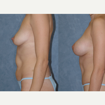 25-34 year old woman treated with Mommy Makeover after 3583744