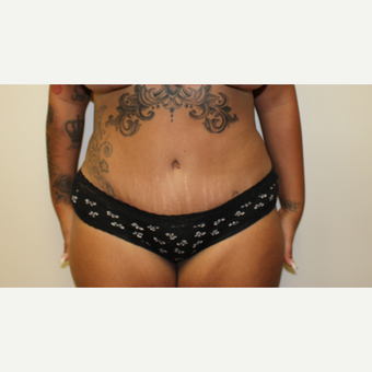 Tummy Tuck after 3417757
