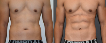 25-34 year old man treated with Vaser Liposuction before 4599318