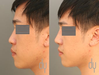 24 year old male before and after nonsurgical Asian rhinoplasty. before 1034901