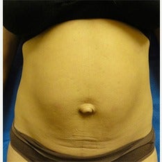 35-44 year old woman treated with Tummy Tuck before 1838603