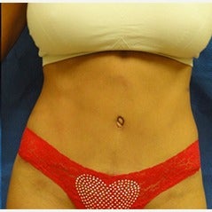 35-44 year old woman treated with Tummy Tuck after 1838603