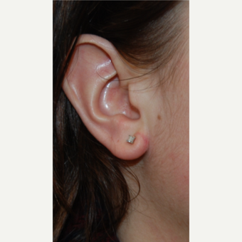 25-34 year old woman treated with Ear Lobe Reduction Surgery after 3508258