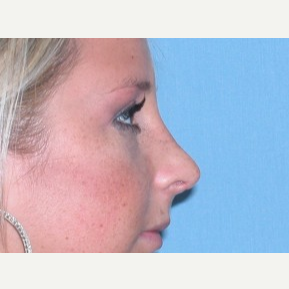 18-24 year old woman treated with Rhinoplasty after 3743262