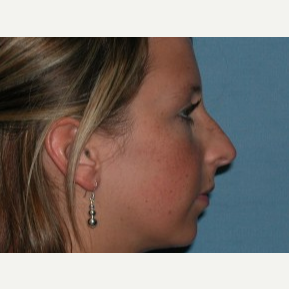 18-24 year old woman treated with Rhinoplasty before 3743262