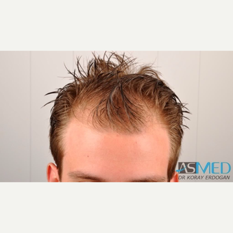 25-34 year old man treated with FUE Hair Transplant before 3091520