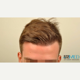 25-34 year old man treated with FUE Hair Transplant after 3091520