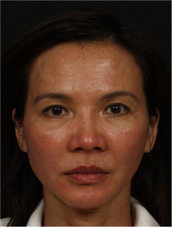 Ultherapy after 461430