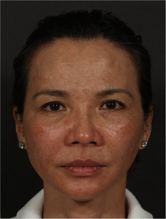 Ultherapy before 461430