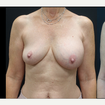 35-44 year old woman treated with Mentor Breast Implants before 3731606