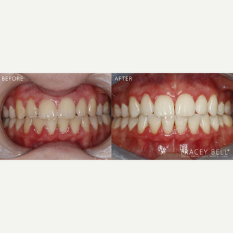 35-44 year old woman treated with Teeth Whitening before 3541708