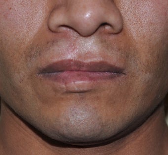 32 Year Old Male Treated For A Cleft Lip after 972740