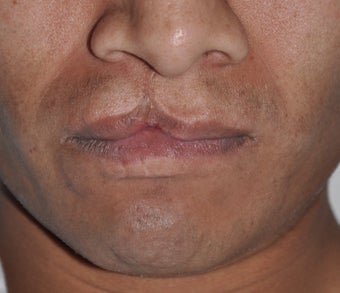 32 Year Old Male Treated For A Cleft Lip before 972740
