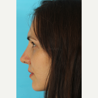 25-34 year old woman treated with Revision Rhinoplasty after 3630153
