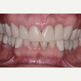 35-44 year old woman treated with Dental Implants after 3104335